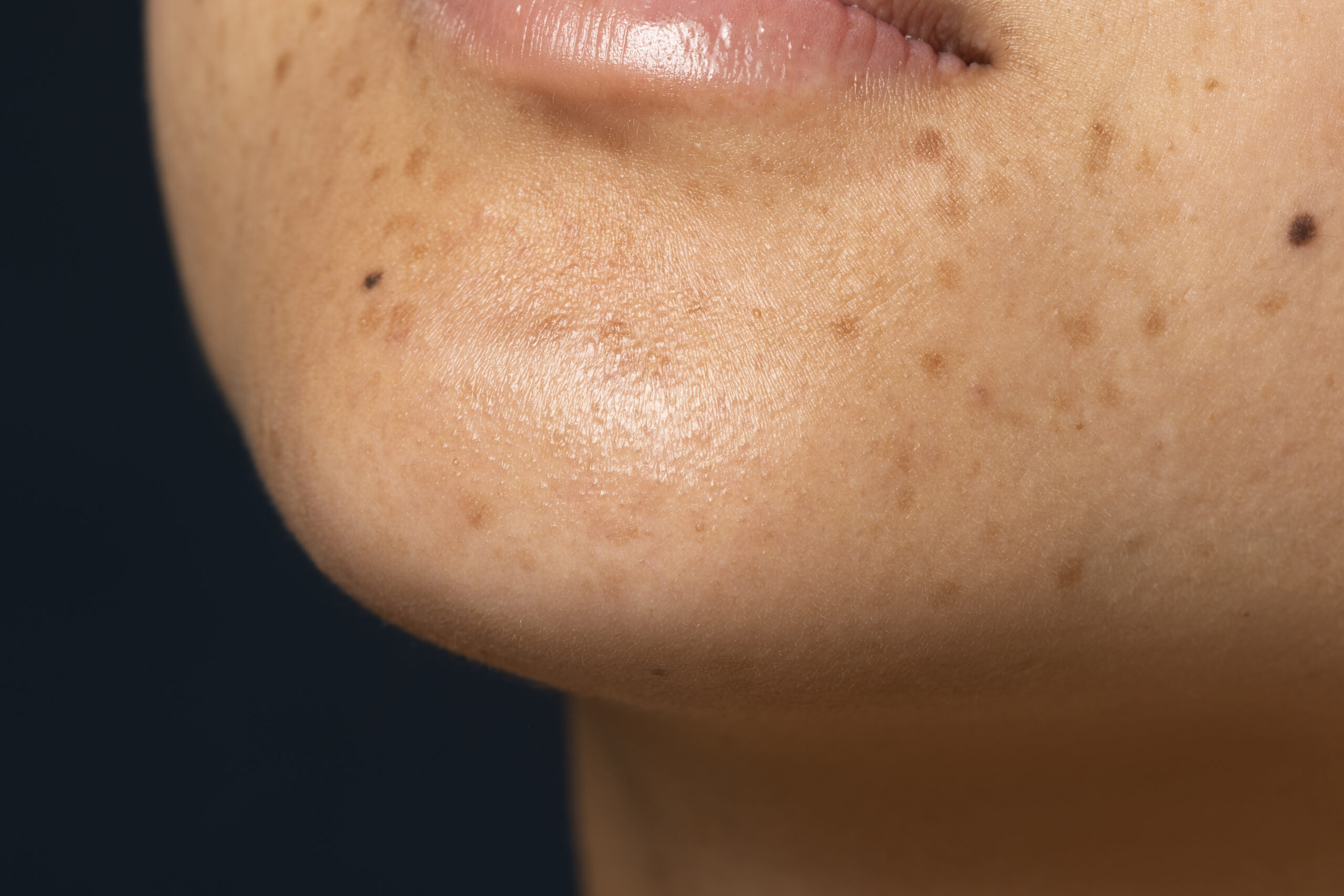 manchinhas escuras na pele causas tipos e como tratar guia completo dermatologia
